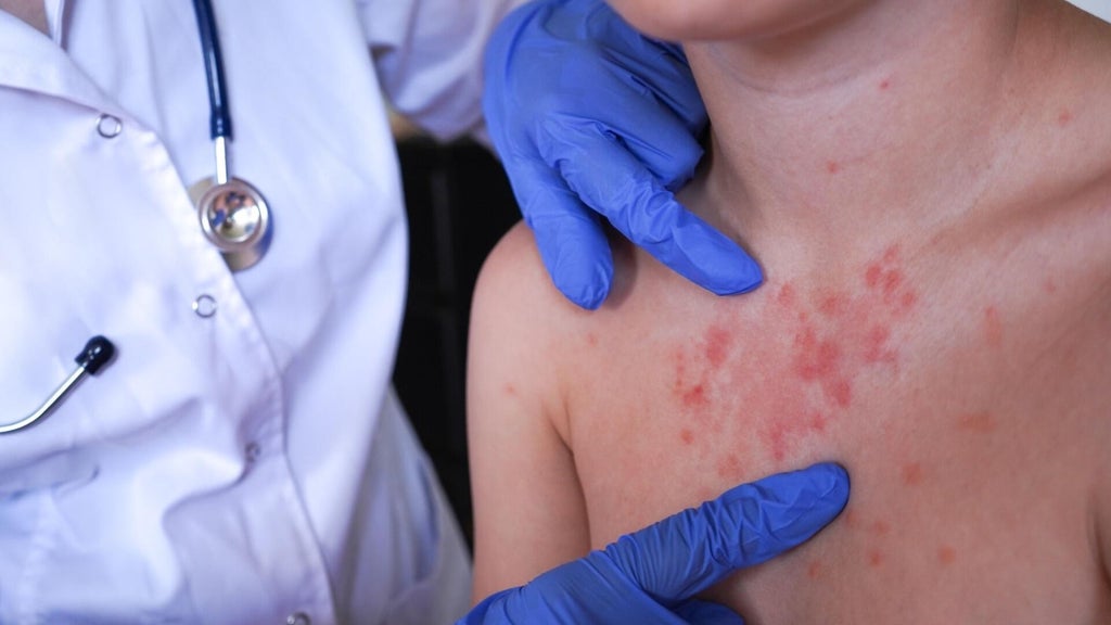 Minnesota's 80 measles cases this year are the most since 1990, health officials say — Bloomington Health news