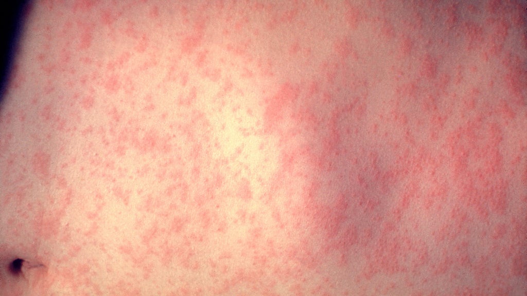 25 cases of measles identified in central, southeastern Minnesota, MDH says — WCCO / CBS Minnesota, Bloomington Health news